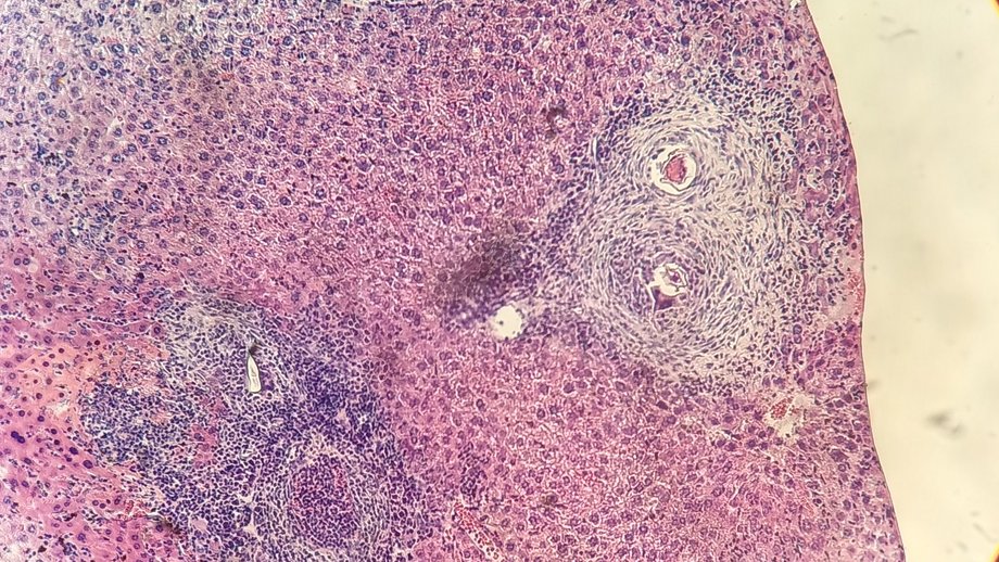 S. mansoni Granulom: Hämatoxylin/Eosin-Färbung eines Leberschnitts von einer Maus, die 14 Wochen lang mit S. mansoni infiziert war. Vergrößerte Ansicht des Lebergranuloms, das die Parasiteneier umgibt