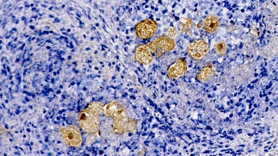 Die immunhistologische Färbung zeigt blau gefärbte Leberzellen der Maus, Leberabszess braun gefärbt, Leberabszess hervorgerufen durch Amöben der Gattung Entamoeba histolytica.