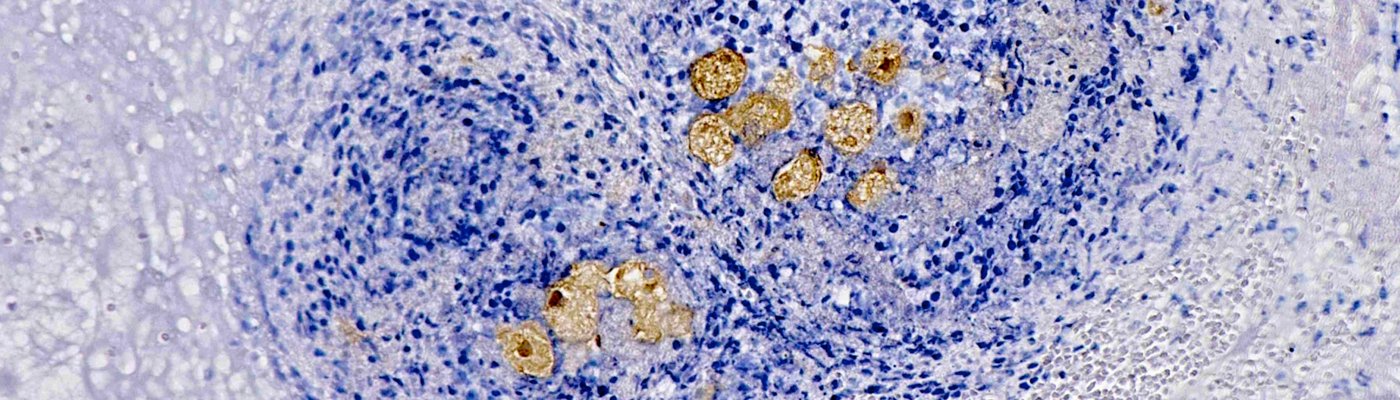 Immunohistological staining shows blue-stained mouse liver cells, liver abscess stained brown, liver abscess caused by amoebae of the genus Entamoeba histolytica