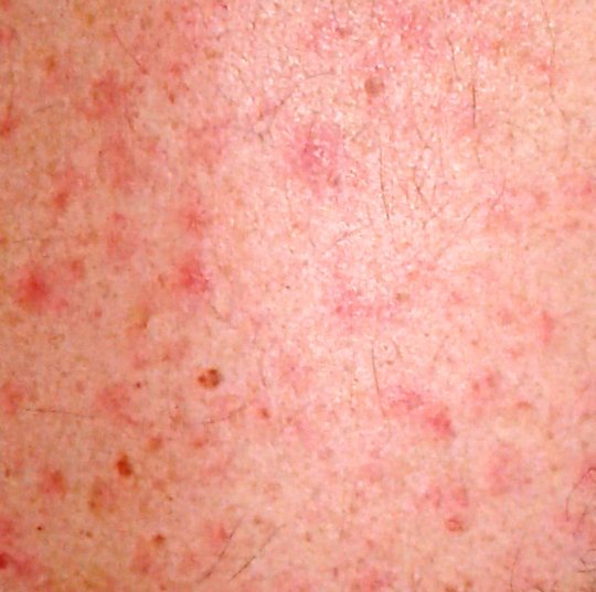 Picture of an exanthema in spotted fever - the rash in tick-bite fever looks similar. The photo shows an exanthema of spotted fever. Several red spots are visible on the skin.
