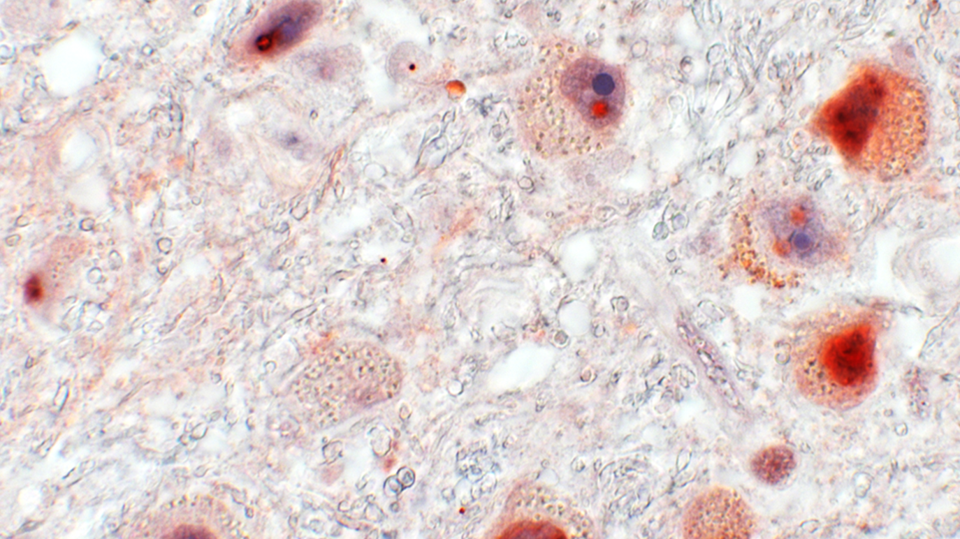 Zu sehen ist eine mikroskopische Aufnahme des Bornavirus in einer Probe. an der rechten Seite sieht man braun-rötlich eingefärbt zwei rundliche Bornaviren.