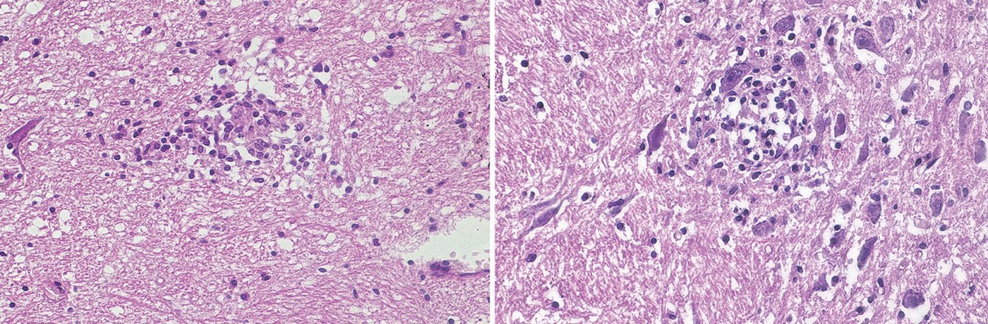 Typisches Knötchen, das durch Rickettsien der Typhusgruppe im Gehirn verursacht wird: Zwei Bilder, auf denen Zellenin Lila zu sehen sind. Auf beiden Bildern ist etwa mittig eine Anhäufung dunkel lila Zellen ist zu sehen.