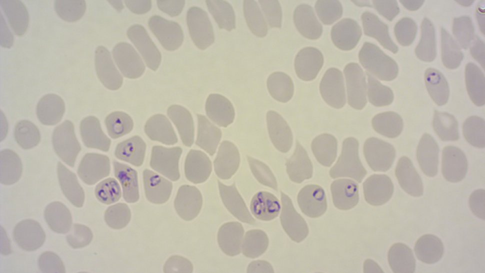 Malariaparasiten Die mikroskopische Aufnahme zeigt rote Blutkörperchen, von denen einige mit Malariaparasiten befallen sind.