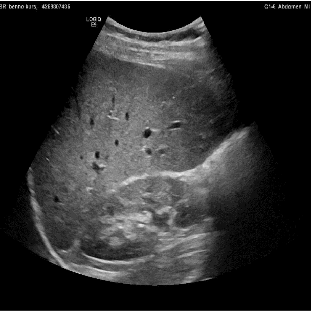 Die Abbildung zeigt ein Ultraschallbild des Bauches. Das Bild ist hell/mittelgrau mit nur wenigen dunklen Flecken.