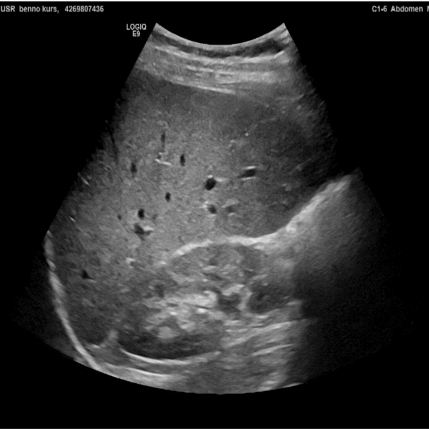 The picture shows a ultrasound image of the abdomen. The image is light/medium grey with only a few dark spots.