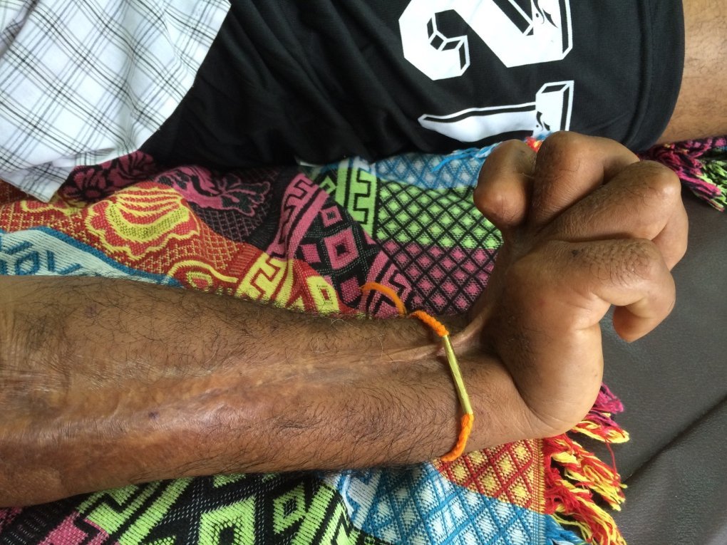 Close-up of a man's right hand and forearm. A long scar stretches across the forearm to the hand. The hand is raised and all fingers are clawed. He is sitting on a coloured blanket.