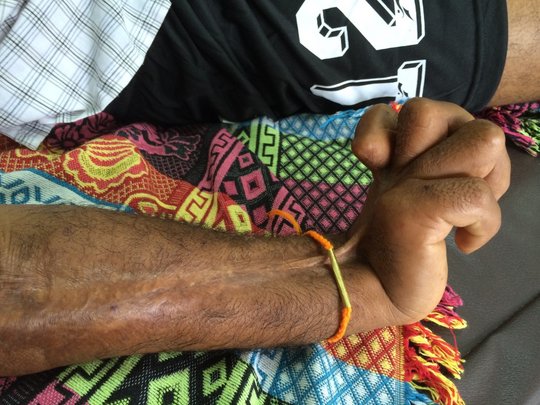 Close-up of a man's right hand and forearm. A long scar stretches across the forearm to the hand. The hand is raised and all fingers are clawed. He is sitting on a coloured blanket.