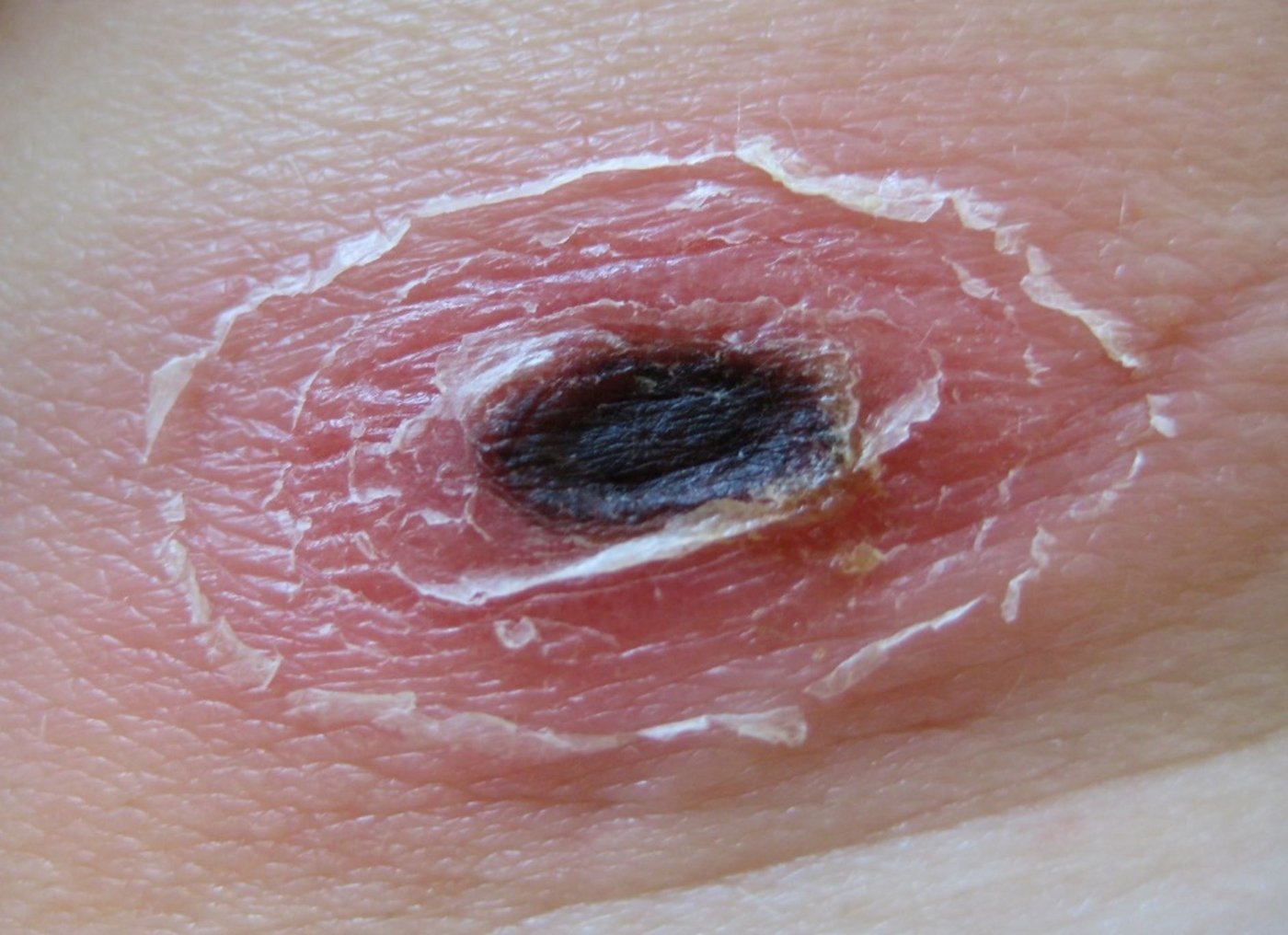 Zu sehen ist ein typischer Eschar beim Zeckenbissfieber. auf der Haut sieht man einen schwarzen, ovalen Fleck, der von einem roten, mit sich pellender Haut umringt ist.