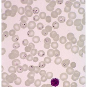 [Translate to English:] Auf der mikroskopischen Aufnahme sind rote Blotkörperchen zu sehen, von denen ein paar mit dem Malariaparasiten befallen sind.