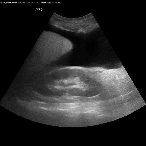 The image shows an ultrasound image of the abdomen with a large dark contiguous area at the top right of the image spreading upwards and to the centre left of the image.