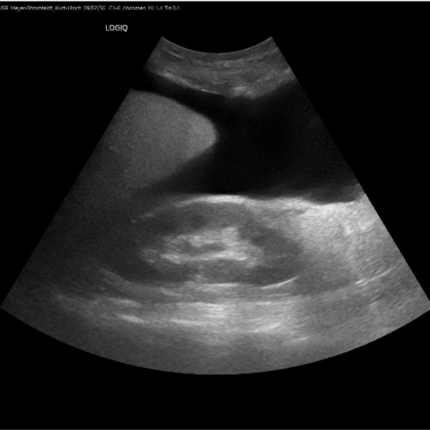 Das Bild zeigt ein Ultraschallbild des Abdomens mit einem großen dunklen zusammenhängenden Bereich oben rechts im Bild, der sich nach oben und in die linke Bildmitte ausbreitet.