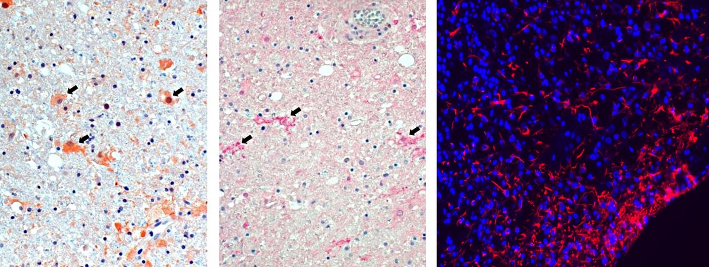 Astrozyten (links) und Mikroglia (Mitte) im Aktivierungszustand während der Infektion.