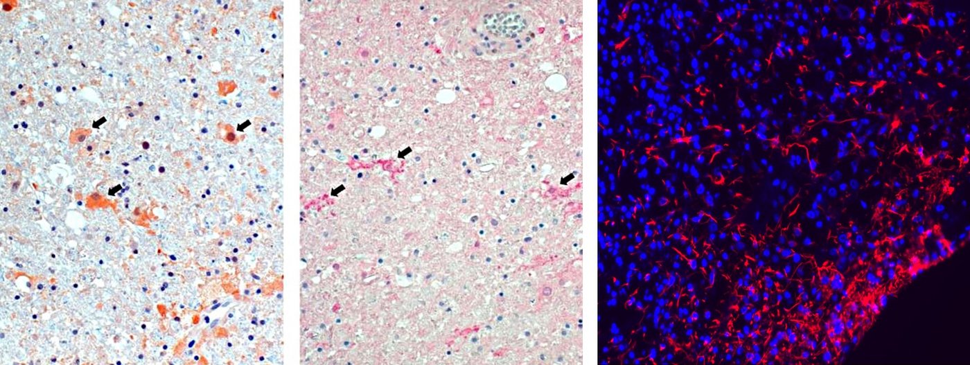 Astrozyten (links) und Mikroglia (Mitte) im Aktivierungszustand während der Infektion.