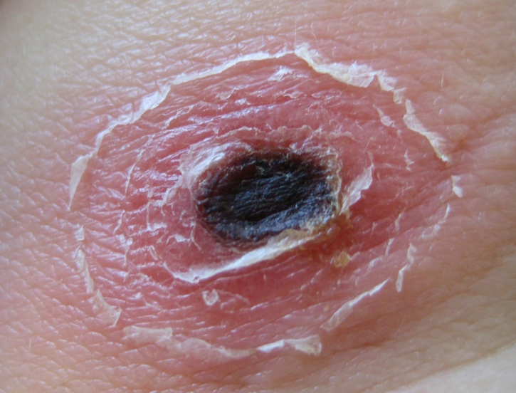 You can see a typical eschar in tick-bite fever. On the skin you can see a black, oval spot surrounded by a red, peeling skin.