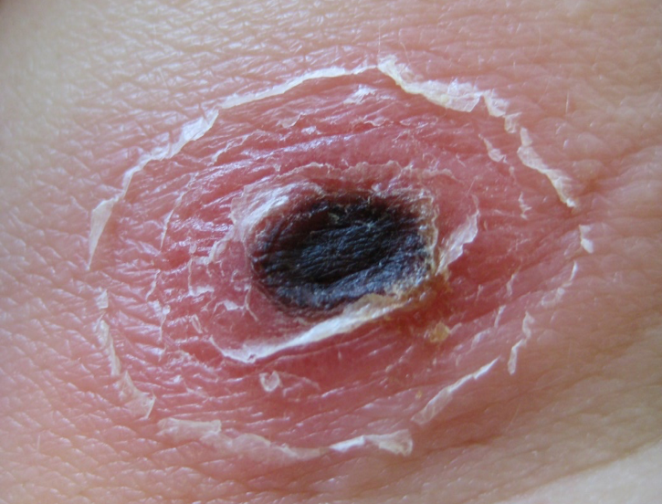Typical eschar in tick-bite fever You can see a typical eschar in tick-bite fever. On the skin you can see a black, oval spot surrounded by a red, peeling skin.