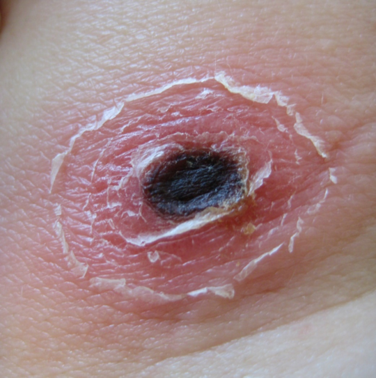 Typical eschar in tick-bite fever You can see a typical eschar in tick-bite fever. On the skin you can see a black, oval spot surrounded by a red, peeling skin.