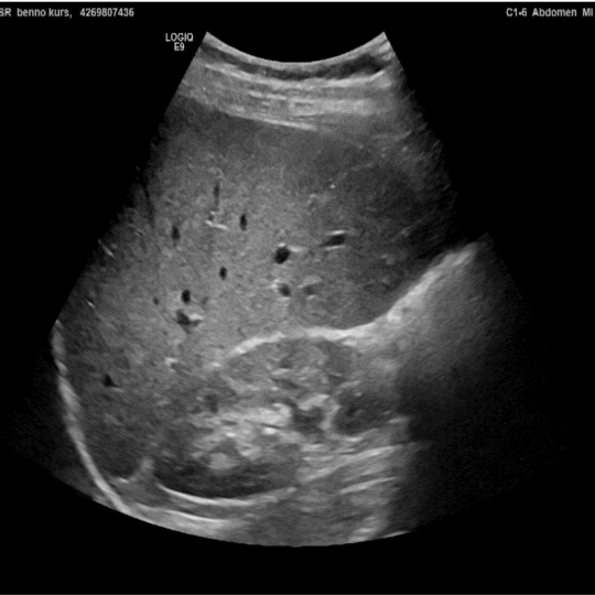 Die Abbildung zeigt ein Ultraschallbild des Bauches. Das Bild ist hell/mittelgrau mit nur wenigen dunklen Flecken.