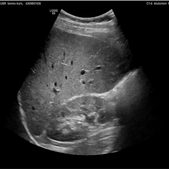 Normal ultrasound of abdomen. The picture shows a ultrasound image of the abdomen. The image is light/medium grey with only a few dark spots.