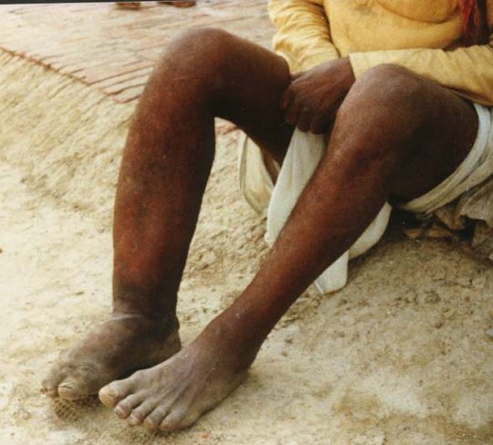 Foto zweier nackter Männerbeine, das eine deutlich geschwollen.