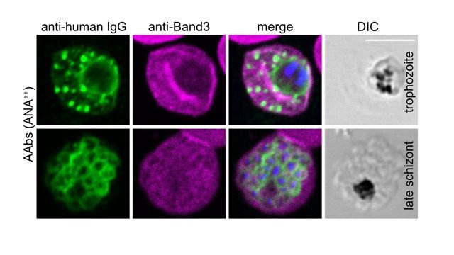 Fluoreszenzaufnahme zeigt den Malariaparasiten in einem vielkernigen Entwicklungsstadium, wie er rote Blutzellen befallen hat.