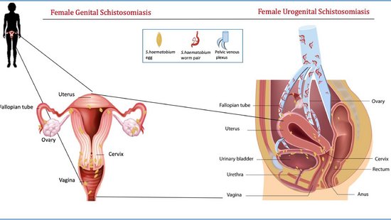 Übersicht über die weiblichen Genitalien, links der Eierstock mit Gebärmutter, Rechts im Schnitt durch den weiblichen Unterleib. In gelb sind die Eier angedeutet, mit kleinen Wurmbildern die Würmer, die die weiblichen Genitalien befallen.