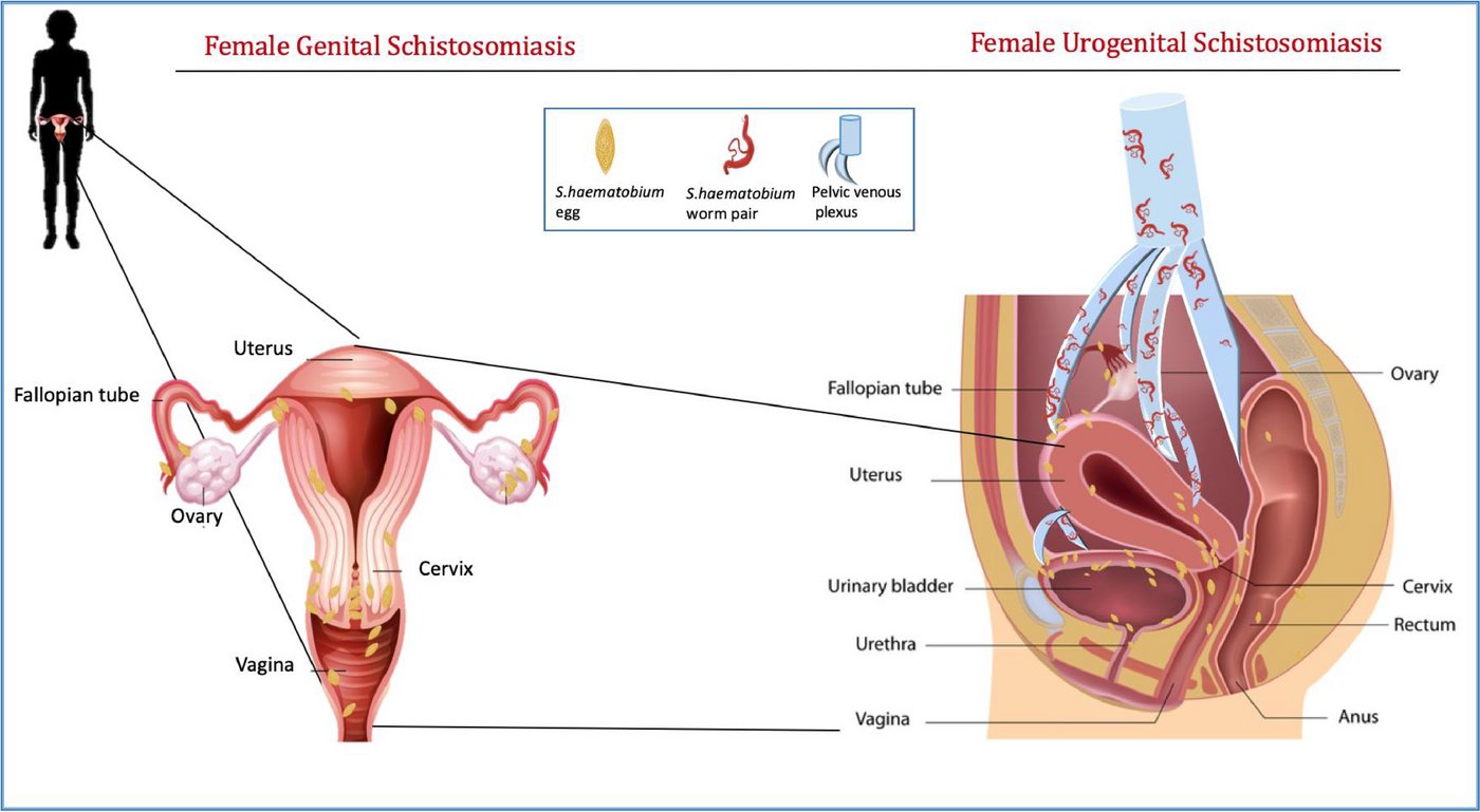 Übersicht über die weiblichen Genitalien, links der Eierstock mit Gebärmutter, Rechts im Schnitt durch den weiblichen Unterleib. In gelb sind die Eier angedeutet, mit kleinen Wurmbildern die Würmer, die die weiblichen Genitalien befallen.