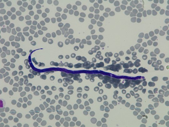 Das Foto zeigt einen lila Loa loa-Wurm (Blutausstrich nach Giemsa gefärbt 1:400).