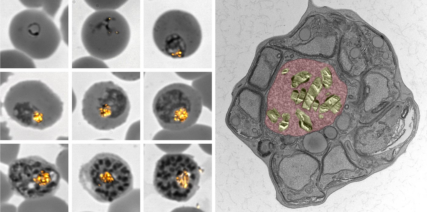 Polarisation microscope or transmission electron microscope image of malaria-infected red blood cells