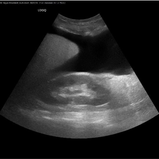 Ultrasound image of the abdomen with large dark area (indicating liquid) between liver and kidney. The image shows an ultrasound image of the abdomen with a large dark contiguous area at the top right of the image spreading upwards and to the centre left of the image.