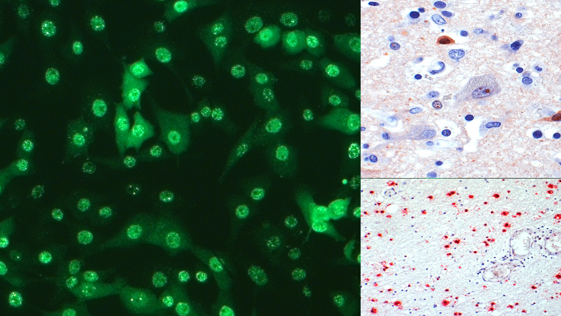 Indirekte Immunfluoreszenz zur Darstellung von Anti-Bornavirus-Antikörpern in Serum und Liquor (links) sowie Immunhistologie für Virus-Antigen (rechts oben) und in situ-Hybridisierung für Virus-RNA (rechts unten).