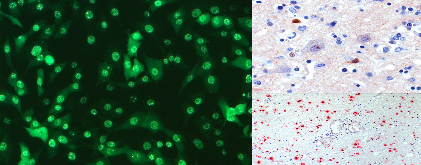 Indirekte Immunfluoreszenz zur Darstellung von Anti-Bornavirus-Antikörpern in Serum und Liquor (links) sowie Immunhistologie für Virus-Antigen (rechts oben) und in situ-Hybridisierung für Virus-RNA (rechts unten).