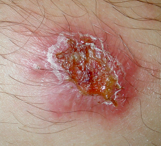 The picture shows a non-healing skin ulcer, the so-called aleppo bump.