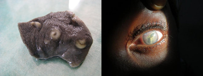 Armillifer armillatus infection of the liver and Armillifer grandis infection of the eye, Democratic Republic of The Congo.