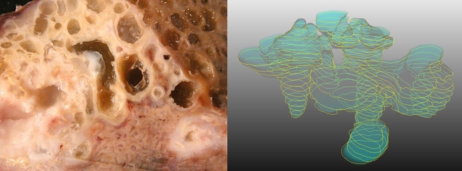 Human Echinococcus multilocularis lesion (left) and 3D-reconstruction of larval growth in tissue (right).