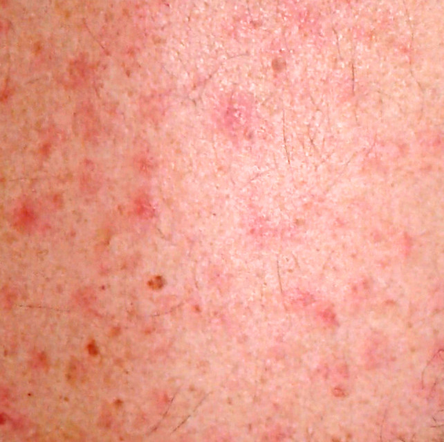 The photo shows an exanthema of spotted fever. Several red spots are visible on the skin.